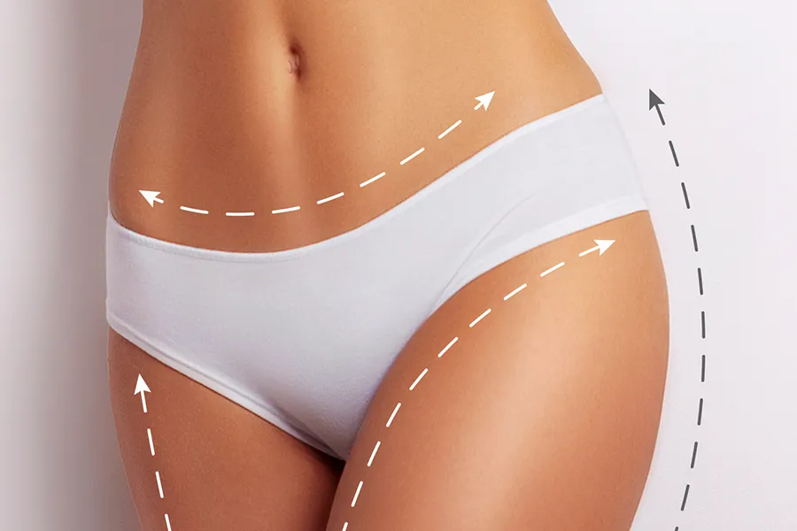 EMSculpt-Pelvic-Sculpting-Clinic A woman's midriff with lines denoting areas to tone. Get EMSculpt® Pelvic Sculpting from Healthy Aging Medical Centers of New Jersey in Northern New Jersey.